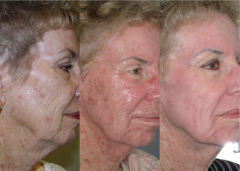 Visuel de r&eacute;sultats d'un traitement de phototh&eacute;rapie