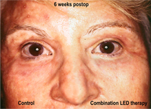 Visuel de r&eacute;sultat sur un traitement de r&eacute;cup&eacute;ratiion cutan&eacute;e. Photographie prise six semaine apr&egrave;s le d&eacute;but du traitement.
