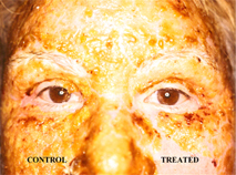 Visuel de r&eacute;sultat sur un traitement de r&eacute;cup&eacute;ration cutan&Eacute;e. Photographie prise au d&eacute;but du traitement.