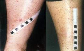 Visuel de r&eacute;sultat montrant l'efficacit&eacute; de la machine Omnilux Revive