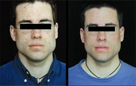 Visuel de r&eacute;sultats des effets d'Omnilux Blue